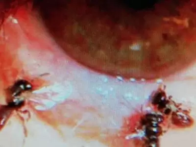 taiwan-mujer-con-abejas-vivas-en-el-interior-del-ojo