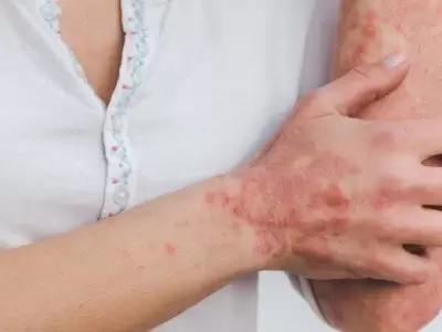 psoriasis-