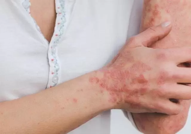 psoriasis-