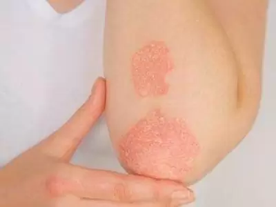 PSORIASIS-(1)