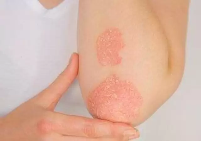 PSORIASIS-(1)