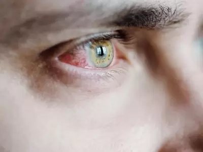 conjuntivitis-jpg.