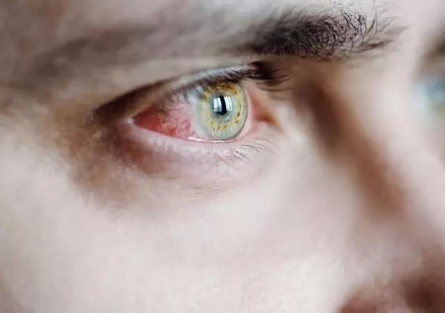 conjuntivitis-jpg.