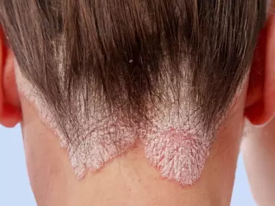 psoriasis-jpg.