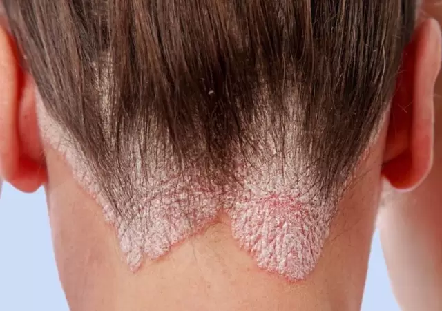 psoriasis-jpg.