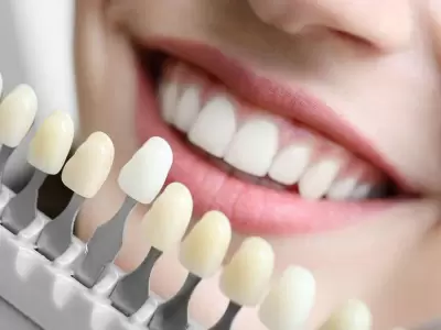 blanqueamiento-dental-jpg.