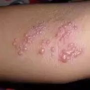 Herpes z�ster: qu� es y como prevenir esta enfermedad