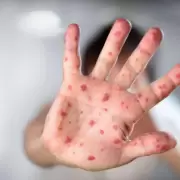 Alerta por una variante del sarampión que escapa a las pruebas