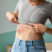 Mes de Concientizaci�n del Herpes Z�ster: riesgos y prevenci�n