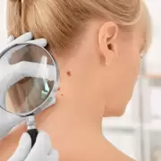 Cirugía de Mohs: la técnica avanzada para tratar el cáncer de piel
