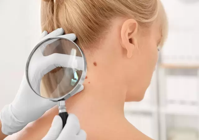 Ciruga de Mohs: la tcnica para el tratamiento del cncer de piel que se realiza en un solo da.