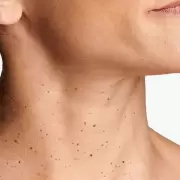 ¿Por qué salen verrugas en el cuello? La ciencia detrás de este incómodo problema