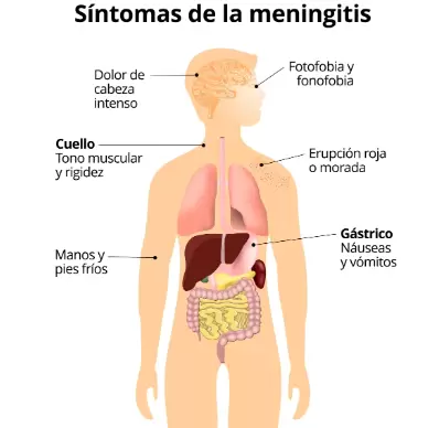 Reconocer los sntomas de la meningitis es fundamental para recibir atencin mdica de inmediato y un tratamiento eficaz.