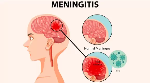 La meningitis deja graves secuelas y aumenta el riesgo de contagio en aglomeraciones.