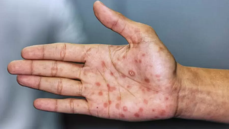 En el año 2023 se registraron más de 32.000 casos de sífilis, la mayor cantidad de contagios de las últimas tres décadas.