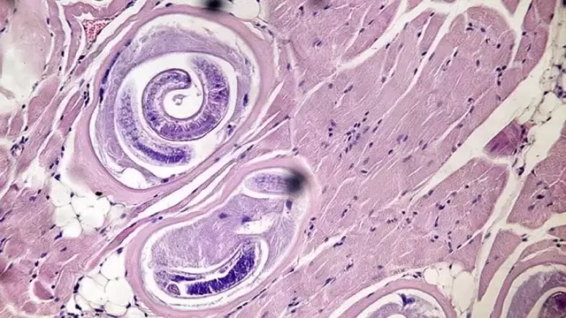 Triquinosis