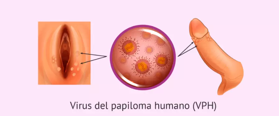 Las verrugas genitales causadas por el virus del papiloma humano (VPH) son peque�as protuberancias parecidas a una coliflor.