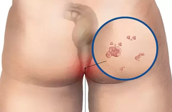 El VPH es la infecci�n de transmisi�n sexual m�s com�n em hombres y mujeres.