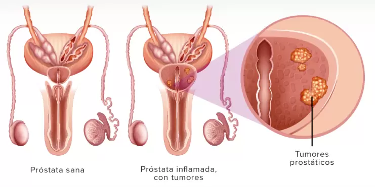 Lo (muy) positivo de este tipo de tumor es que tiene una tasa de curaci�n muy elevada.