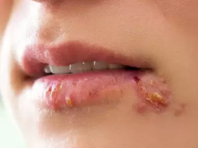 Herpes