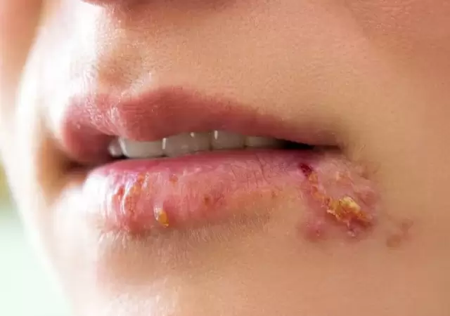 Herpes