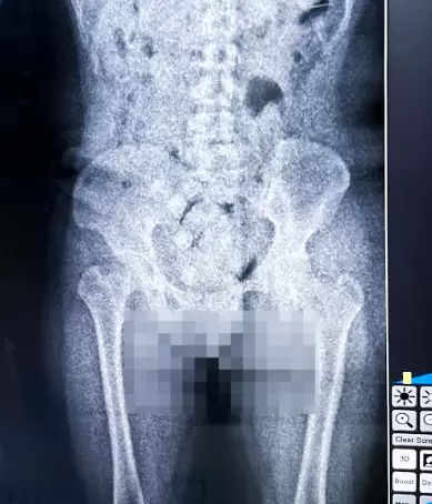 Resultado del escaner corporal practicado al hombre que trat� de ingresar al pa�s coca�na en c�psulas dentro de su cuerpo.