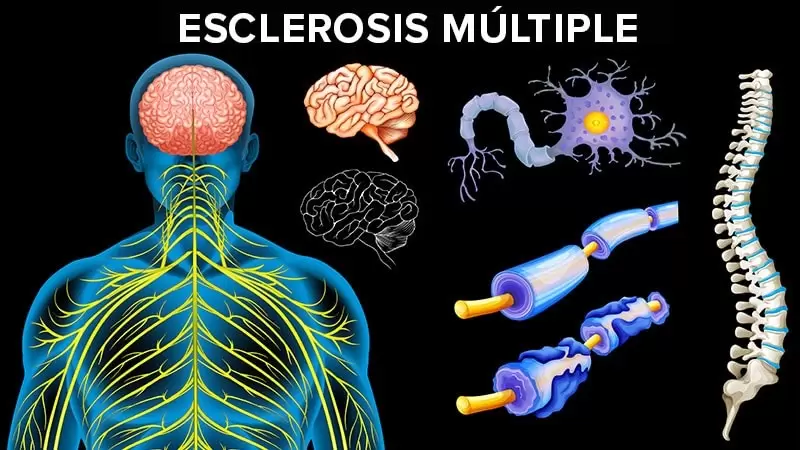 Esclerosis m�ltiple. (Imagen ilustrativa)