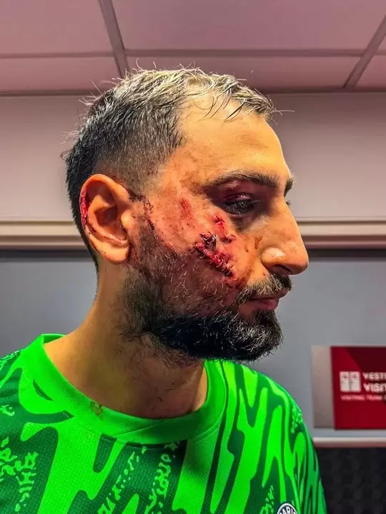 As� qued� el rostro de Donnarumma