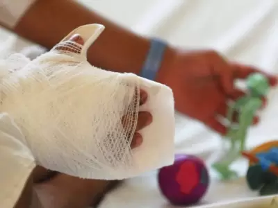 Quemaduras por uso de pirotecnia.