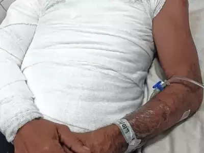 Su hermano le prendi� fuego tras discutir por un sachet de mayonesa