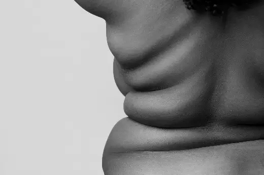 Obesidad