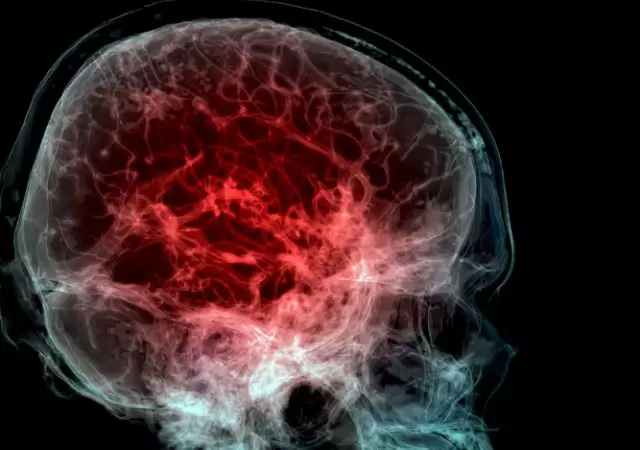 Un estudio descubri� niveles alarmantes de micropl�sticos en el cerebro.