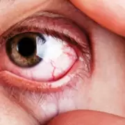 Frotarse los ojos y el alto riesgo de padecer lesiones e infecciones