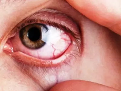 Frotarse los ojos puede producir derrames o lesiones mucho m�s importantes en la c�rnea.