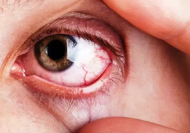 Frotarse los ojos puede producir derrames o lesiones mucho m�s importantes en la c�rnea.