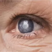 Llega el D�a Mundial del Glaucoma, el enemigo silencioso