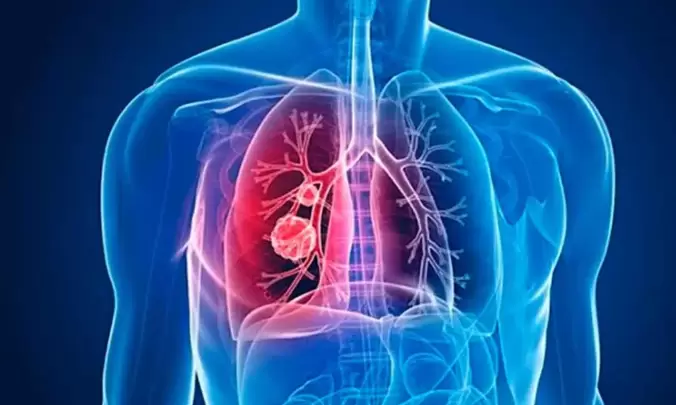 La fisioterapia especializada juega un papel crucial en el manejo de esta afección, al mejorar la capacidad respiratoria.