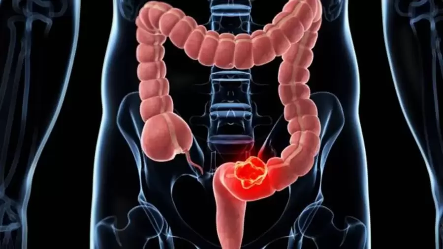 Esta fruta ayuda a prevenir complicaciones relacionadas con el intestino grueso.