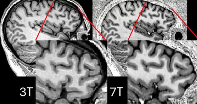 Diferencias de 3T y 7T del mismo participante (Cr�ditos:Simon Jones, Universidad de Cambridge).