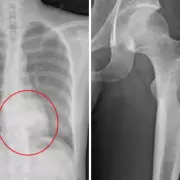 Osteoblastoma: s�ntomas, estudios y tratamiento recomendado