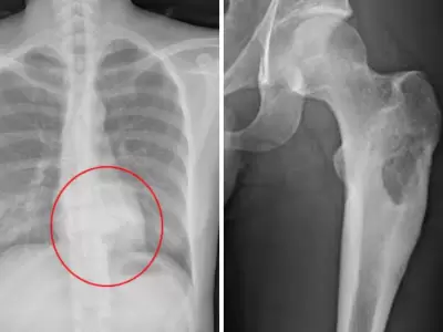 Imagen ilustrativa de osteoblastomas detectados.