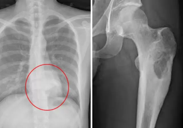 Imagen ilustrativa de osteoblastomas detectados.