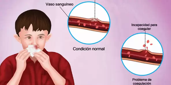 La hemofilia es un trastorno hereditario en el que la sangre no se coagula debido a factores de coagulaci�n insuficientes.