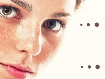 El melanoma es un tumor mel�nico, pigmentado. Puede ser benigno o maligno.