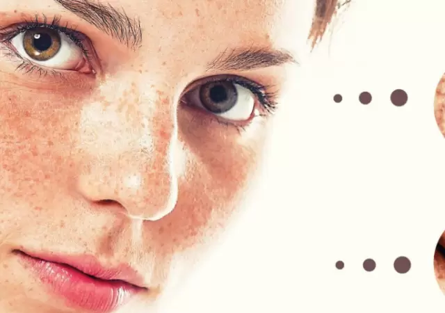 El melanoma es un tumor mel�nico, pigmentado. Puede ser benigno o maligno.