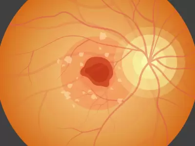Enfermedad de Stargardt. La degeneraci�n precoz de la retina.