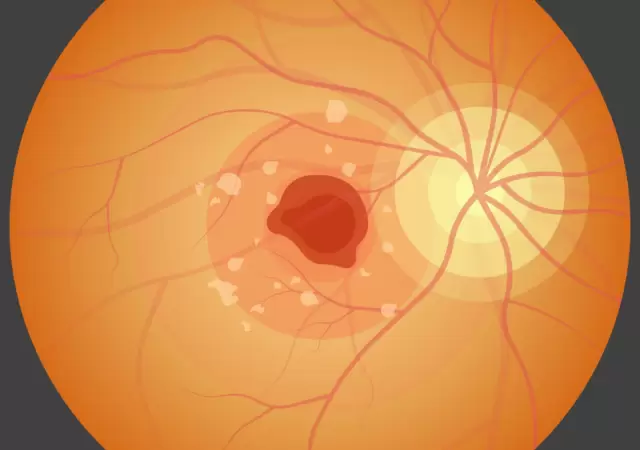 Enfermedad de Stargardt. La degeneraci�n precoz de la retina.