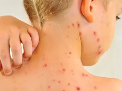 Alerta por sarampi�n en el pa�s: la vacuna, clave para frenar contagios.