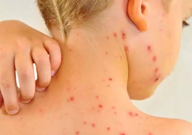 Alerta por sarampi�n en el pa�s: la vacuna, clave para frenar contagios.
