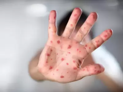 Lesiones t�picas de la viruela del mono.